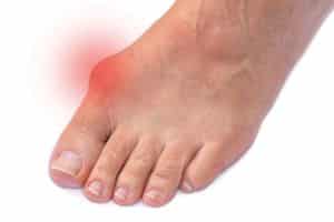 Hallux-valgus